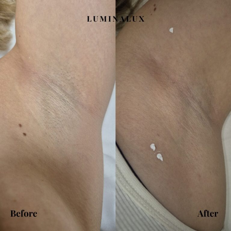 Resultat af permanent hårfjerning i armhulerne