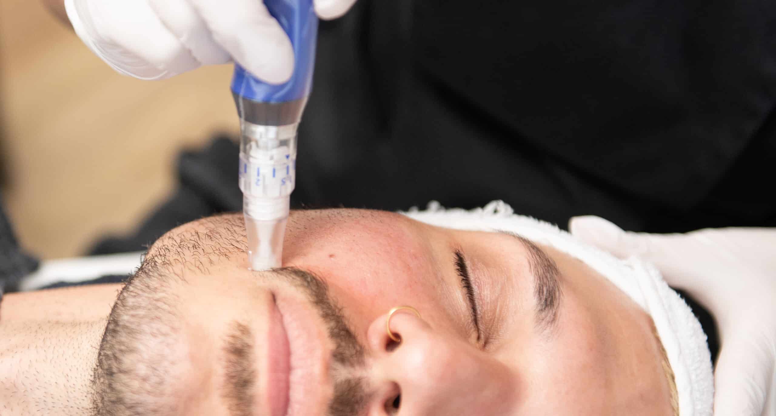 prp- Microneedling til efter ferien hudpleje